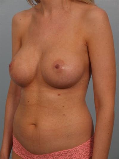 Breast Augmentation Before & After Gallery - Patient 1310278 - Image 2