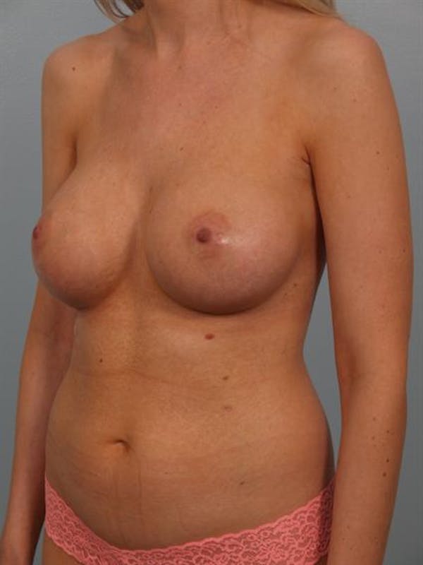 Breast Augmentation Before & After Gallery - Patient 1310278 - Image 2