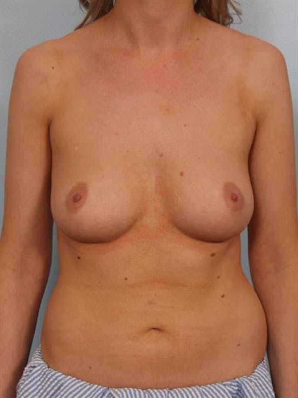 Breast Augmentation Before & After Gallery - Patient 1310278 - Image 5