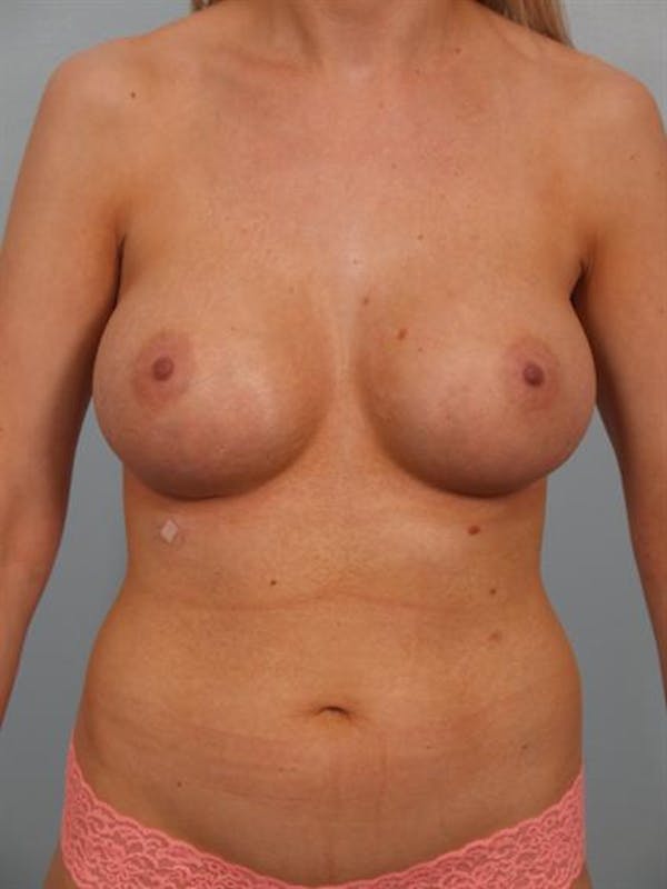 Breast Augmentation Before & After Gallery - Patient 1310278 - Image 6
