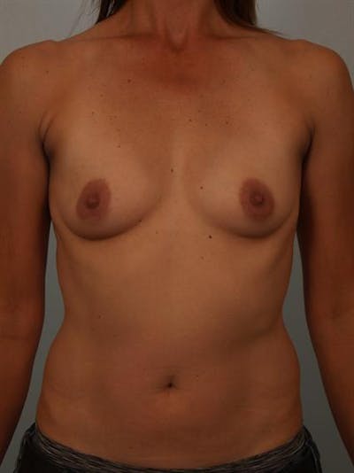 Breast Augmentation Before & After Gallery - Patient 1310280 - Image 1