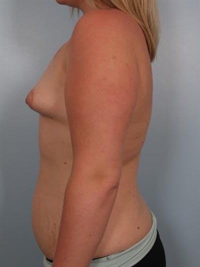 Breast Augmentation Before & After Gallery - Patient 1310281 - Image 1
