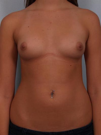 Breast Augmentation Before & After Gallery - Patient 1310282 - Image 1