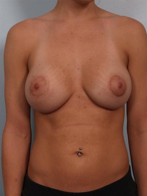 Breast Augmentation Before & After Gallery - Patient 1310287 - Image 4