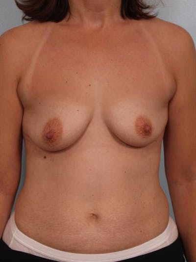 Breast Augmentation Before & After Gallery - Patient 1310289 - Image 1
