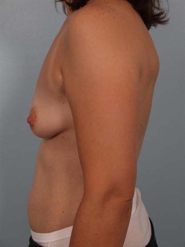 Breast Augmentation Before & After Gallery - Patient 1310289 - Image 3