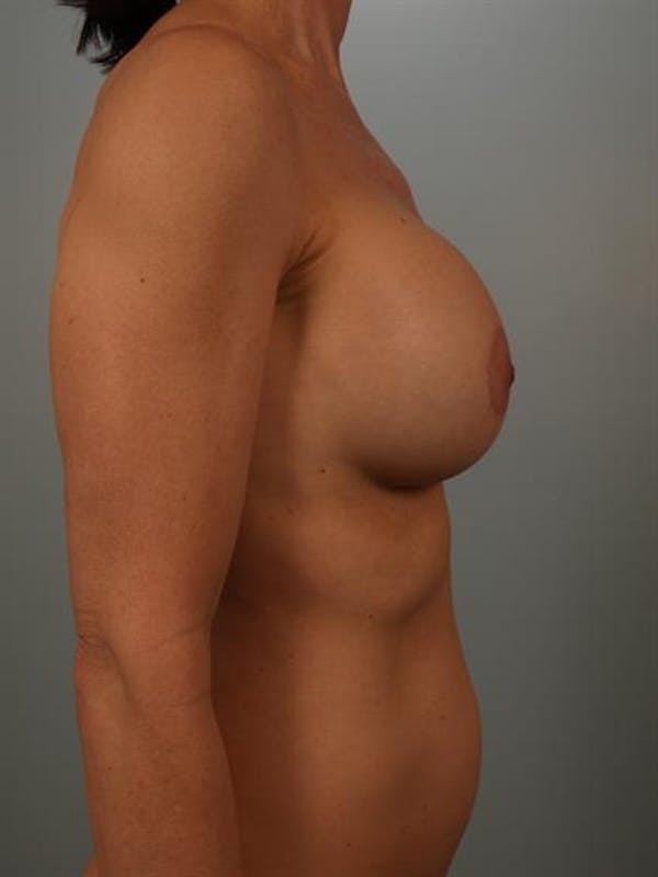 Breast Augmentation Before & After Gallery - Patient 1310290 - Image 6