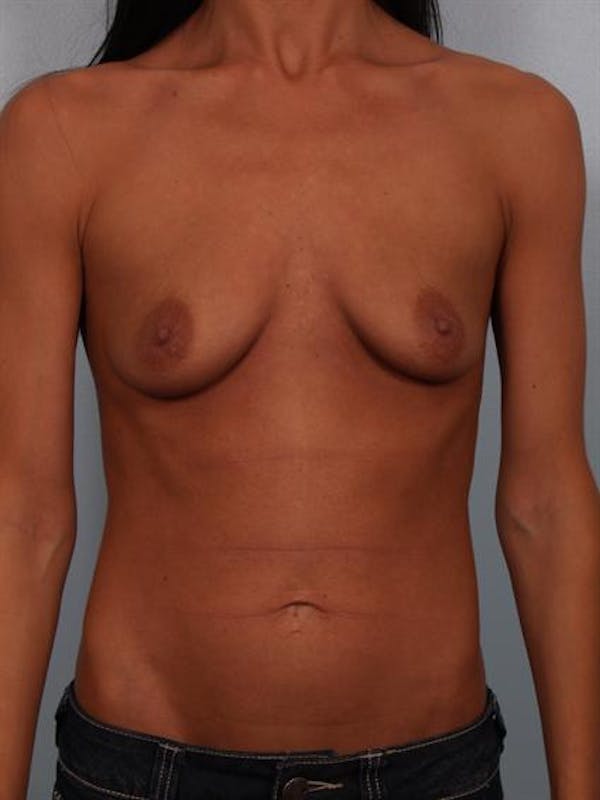 Breast Augmentation Before & After Gallery - Patient 1310293 - Image 1