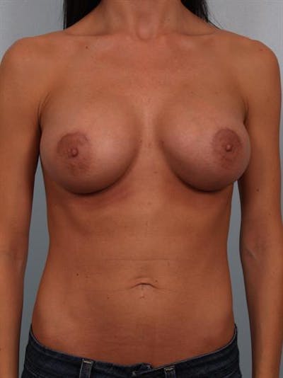Breast Augmentation Before & After Gallery - Patient 1310293 - Image 2