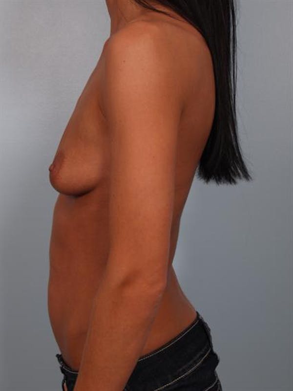 Breast Augmentation Gallery - Patient 1310293 - Image 3