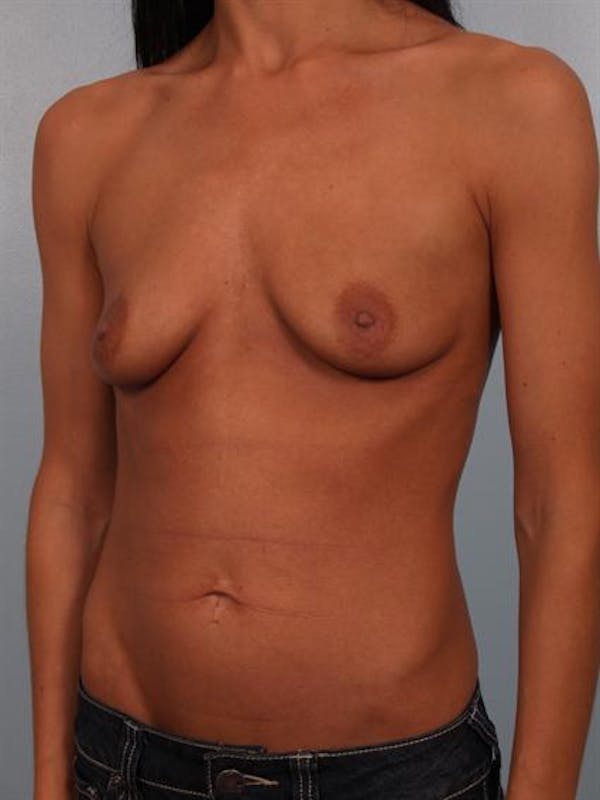 Breast Augmentation Before & After Gallery - Patient 1310293 - Image 5