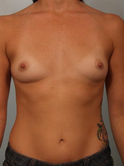 Breast Augmentation Before & After Gallery - Patient 1310294 - Image 1