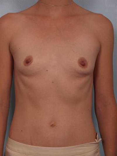 Breast Augmentation Before & After Gallery - Patient 1310296 - Image 1