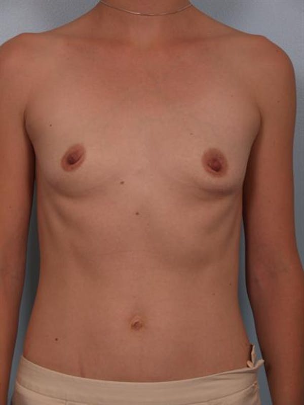 Breast Augmentation Gallery - Patient 1310296 - Image 1
