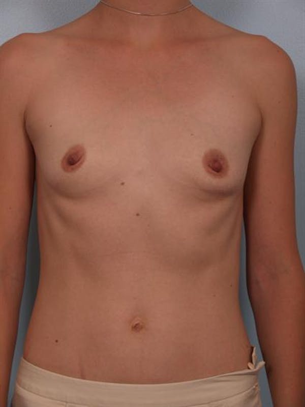 Breast Augmentation Before & After Gallery - Patient 1310296 - Image 1