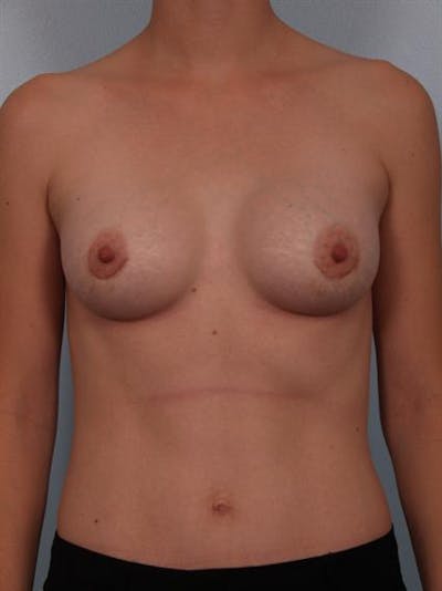 Breast Augmentation Before & After Gallery - Patient 1310296 - Image 2