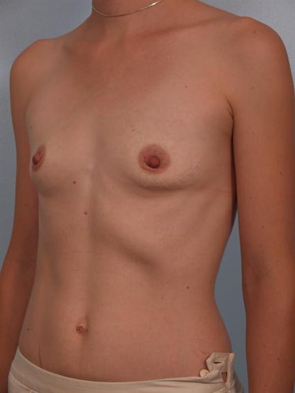 Breast Augmentation Before & After Gallery - Patient 1310296 - Image 5
