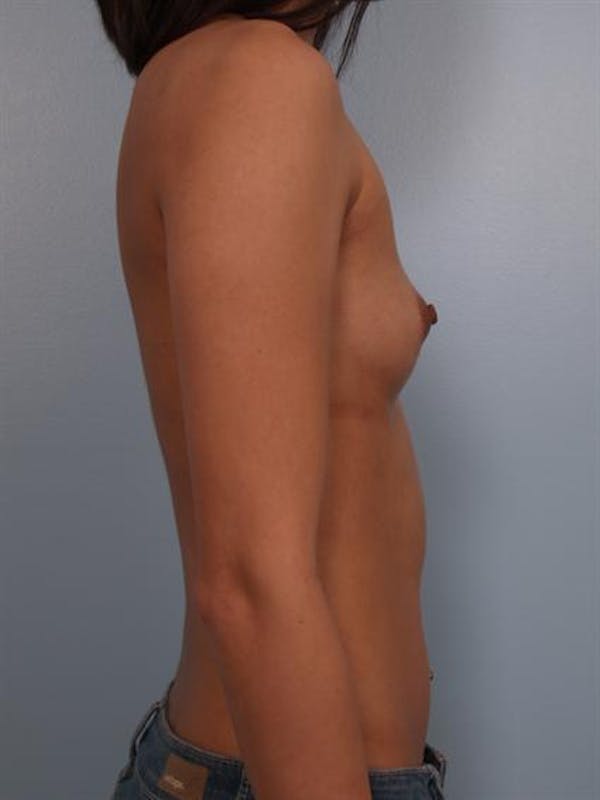 Breast Augmentation Gallery - Patient 1310298 - Image 1