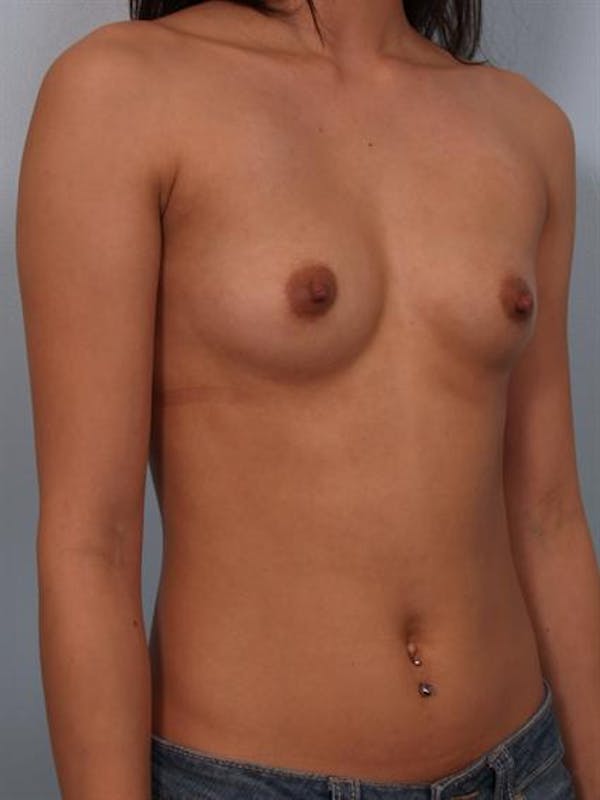 Breast Augmentation Before & After Gallery - Patient 1310298 - Image 3
