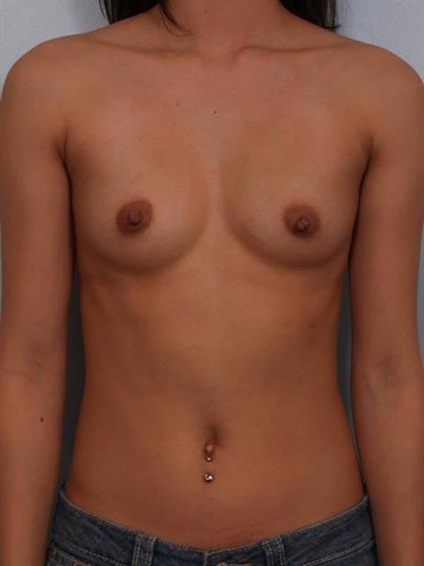 Breast Augmentation Gallery - Patient 1310298 - Image 5