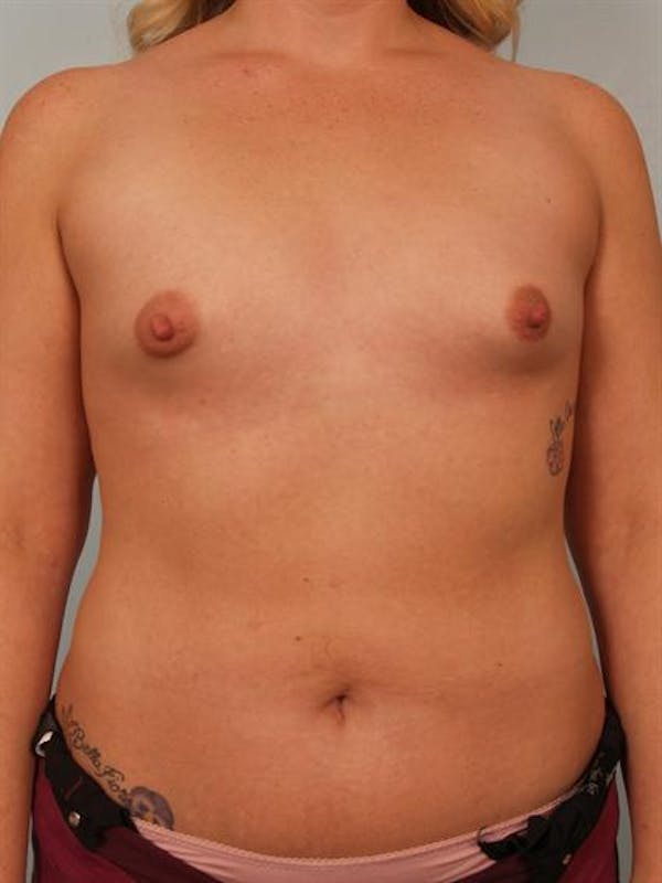 Breast Augmentation Before & After Gallery - Patient 1310300 - Image 1