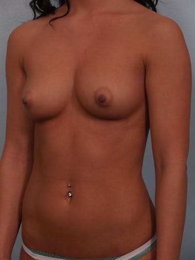 Breast Augmentation Before & After Gallery - Patient 1310305 - Image 1