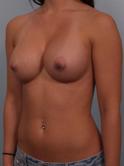 Breast Augmentation Before & After Gallery - Patient 1310305 - Image 2