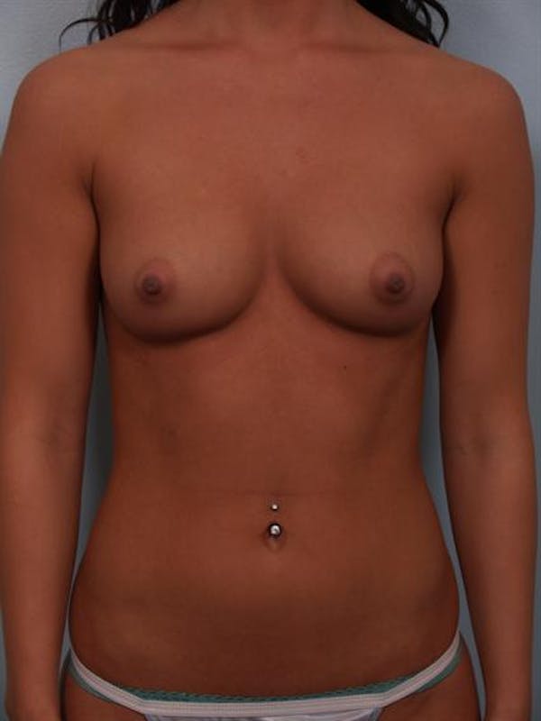 Breast Augmentation Before & After Gallery - Patient 1310305 - Image 3