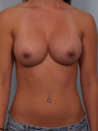 Breast Augmentation Before & After Gallery - Patient 1310305 - Image 4