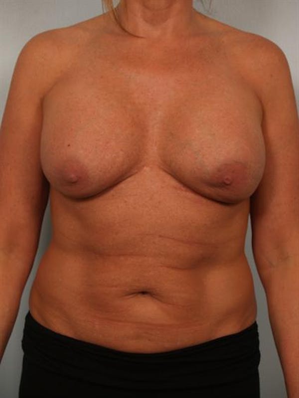 Breast Augmentation Before & After Gallery - Patient 1310307 - Image 1