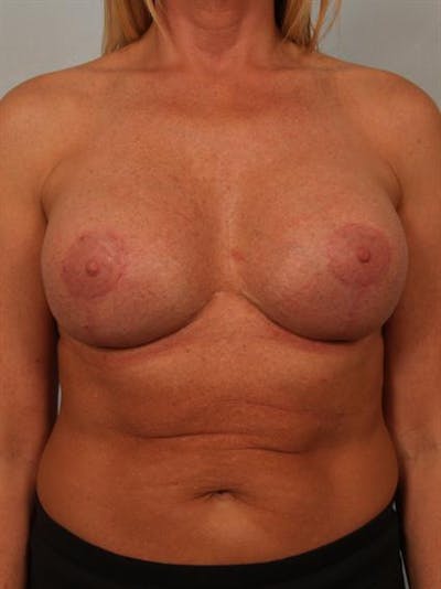 Breast Augmentation Before & After Gallery - Patient 1310307 - Image 2