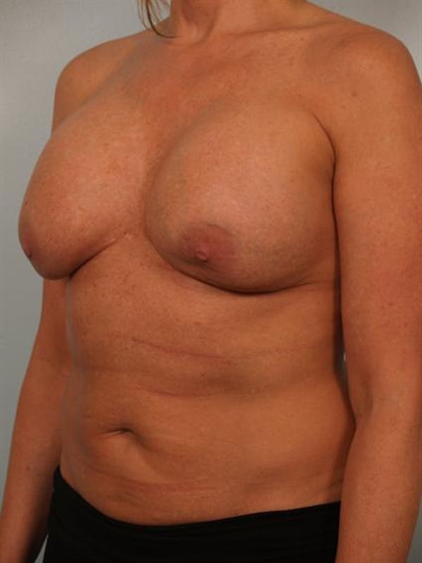 Breast Augmentation Before & After Gallery - Patient 1310307 - Image 3