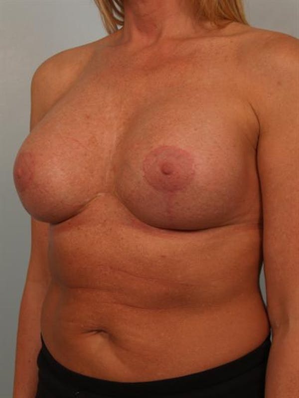 Breast Augmentation Gallery - Patient 1310307 - Image 4