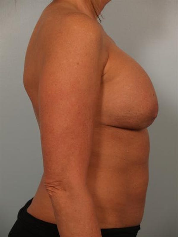 Breast Augmentation Before & After Gallery - Patient 1310307 - Image 5