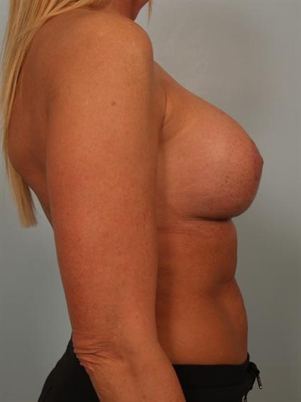 Breast Augmentation Before & After Gallery - Patient 1310307 - Image 6