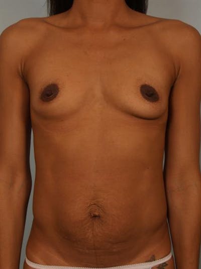 Breast Augmentation Before & After Gallery - Patient 1310308 - Image 1