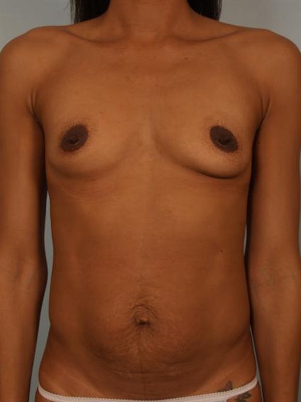 Breast Augmentation Gallery - Patient 1310308 - Image 1