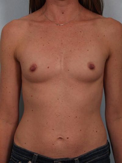 Breast Augmentation Before & After Gallery - Patient 1310310 - Image 1