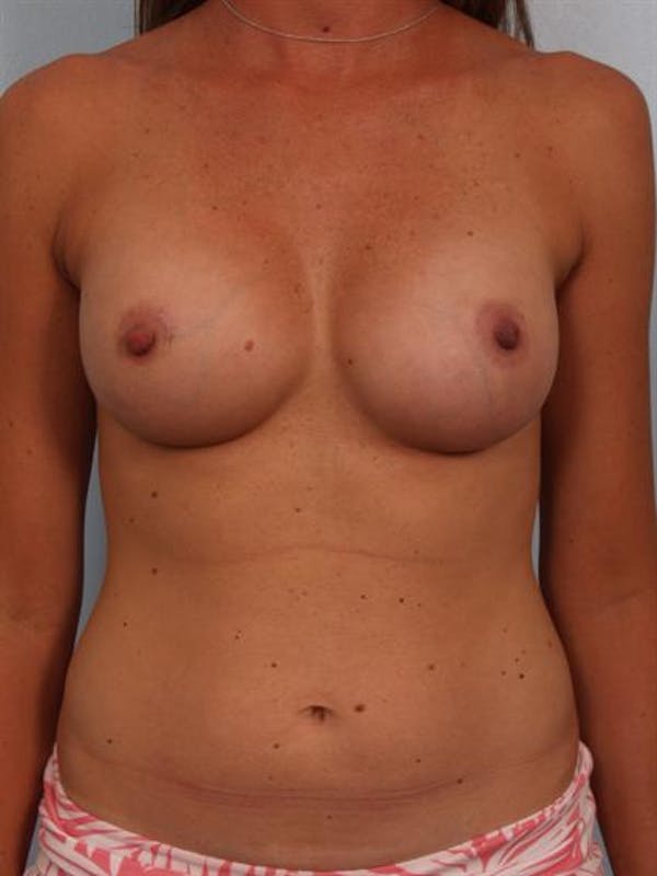 Breast Augmentation Before & After Gallery - Patient 1310310 - Image 2