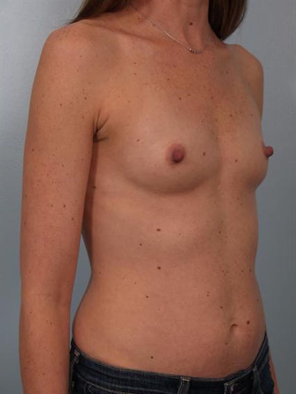 Breast Augmentation Before & After Gallery - Patient 1310310 - Image 5