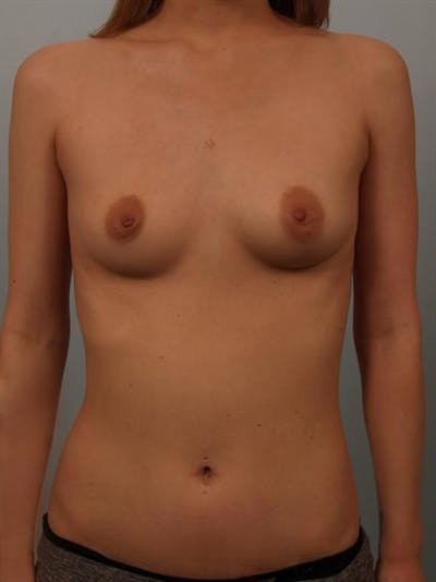 Breast Augmentation Before & After Gallery - Patient 1310311 - Image 1