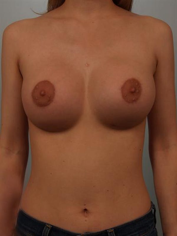 Breast Augmentation Gallery - Patient 1310311 - Image 2