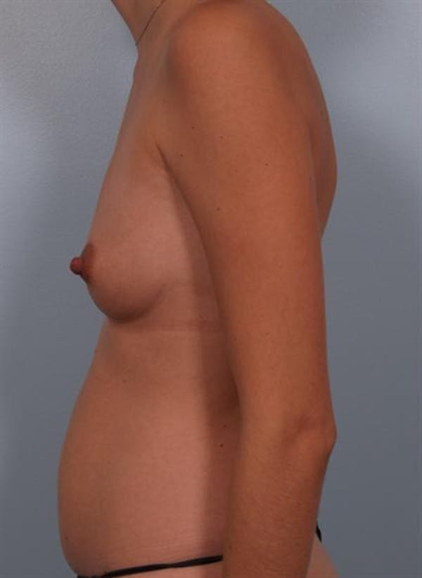 Breast Augmentation Before & After Gallery - Patient 1310314 - Image 1
