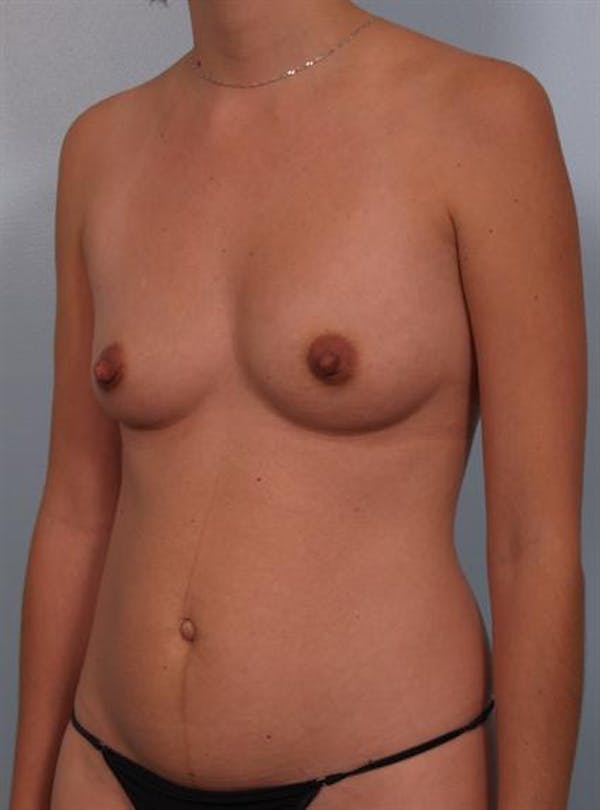 Breast Augmentation Before & After Gallery - Patient 1310314 - Image 3