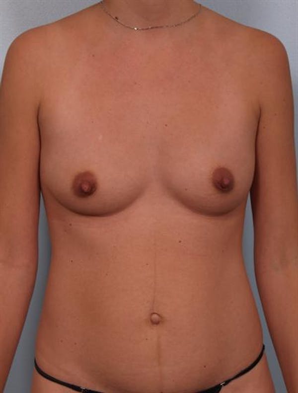 Breast Augmentation Before & After Gallery - Patient 1310314 - Image 5