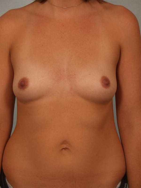 Breast Augmentation Before & After Gallery - Patient 1310315 - Image 1