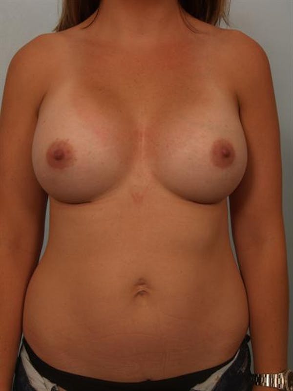 Breast Augmentation Before & After Gallery - Patient 1310315 - Image 2