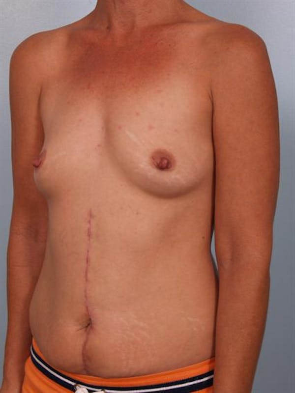 Breast Augmentation Gallery - Patient 1310316 - Image 3