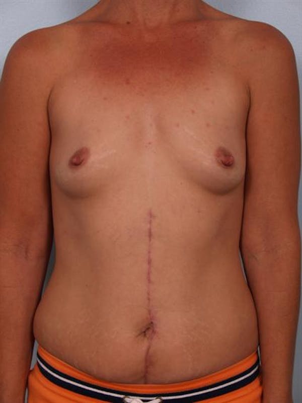 Breast Augmentation Before & After Gallery - Patient 1310316 - Image 5