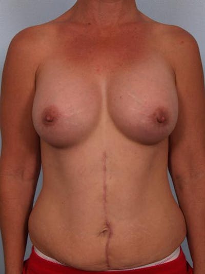Breast Augmentation Before & After Gallery - Patient 1310316 - Image 6